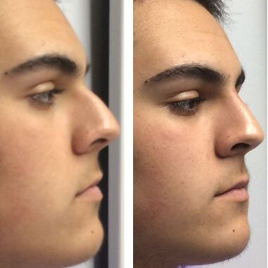 Botox Before and After
