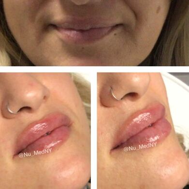Dermal Fillers Before and After