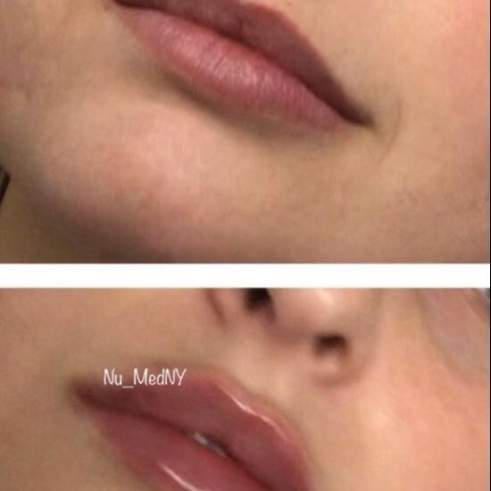 Dermal Fillers Before and After