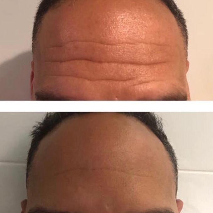 Botox Before and After