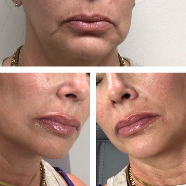 Dermal Fillers Before and After