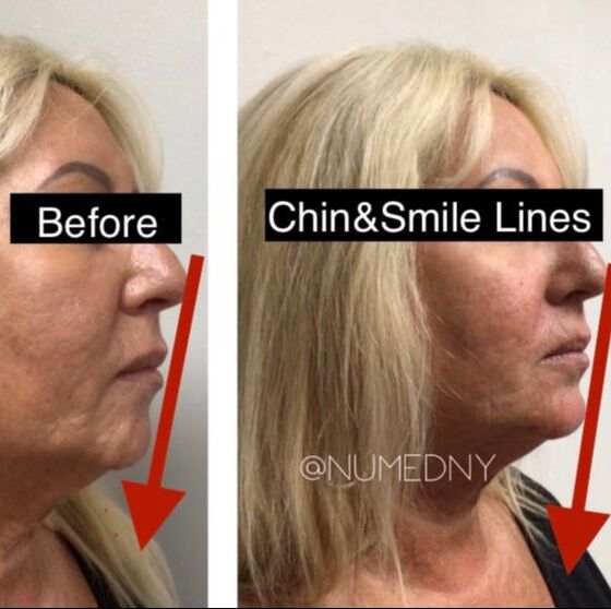 Hair Restoration Before and After