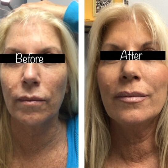 Dermal Fillers Before and After