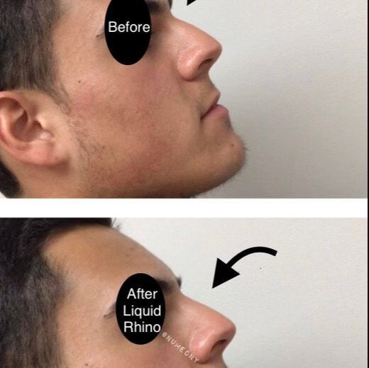 Botox Before and After
